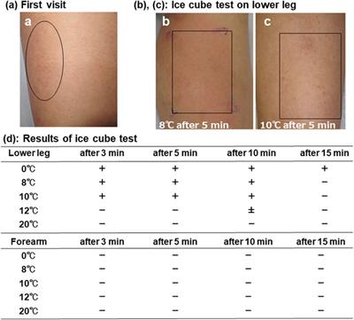 Localized cold urticaria with positive cold stimulation test only on lower legs